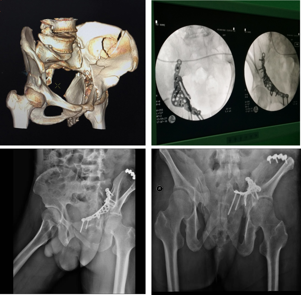Custom Winged Pelvis Reconstruction Locking Compression Plate Factories, Exporter