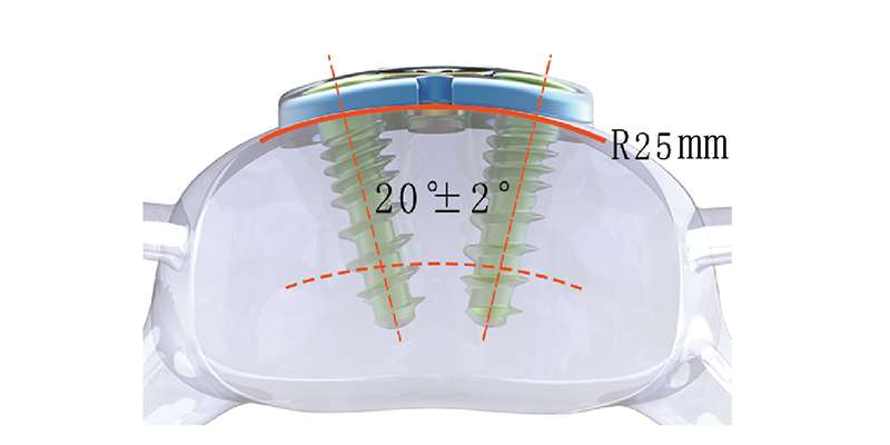 Ligament Resection Reduction