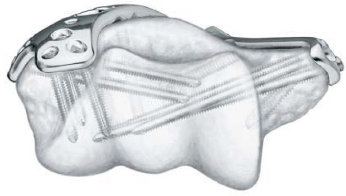 ODM Distal Posterolateral Humerus Locking Compression Plate (with Lateral Support) Product, Products