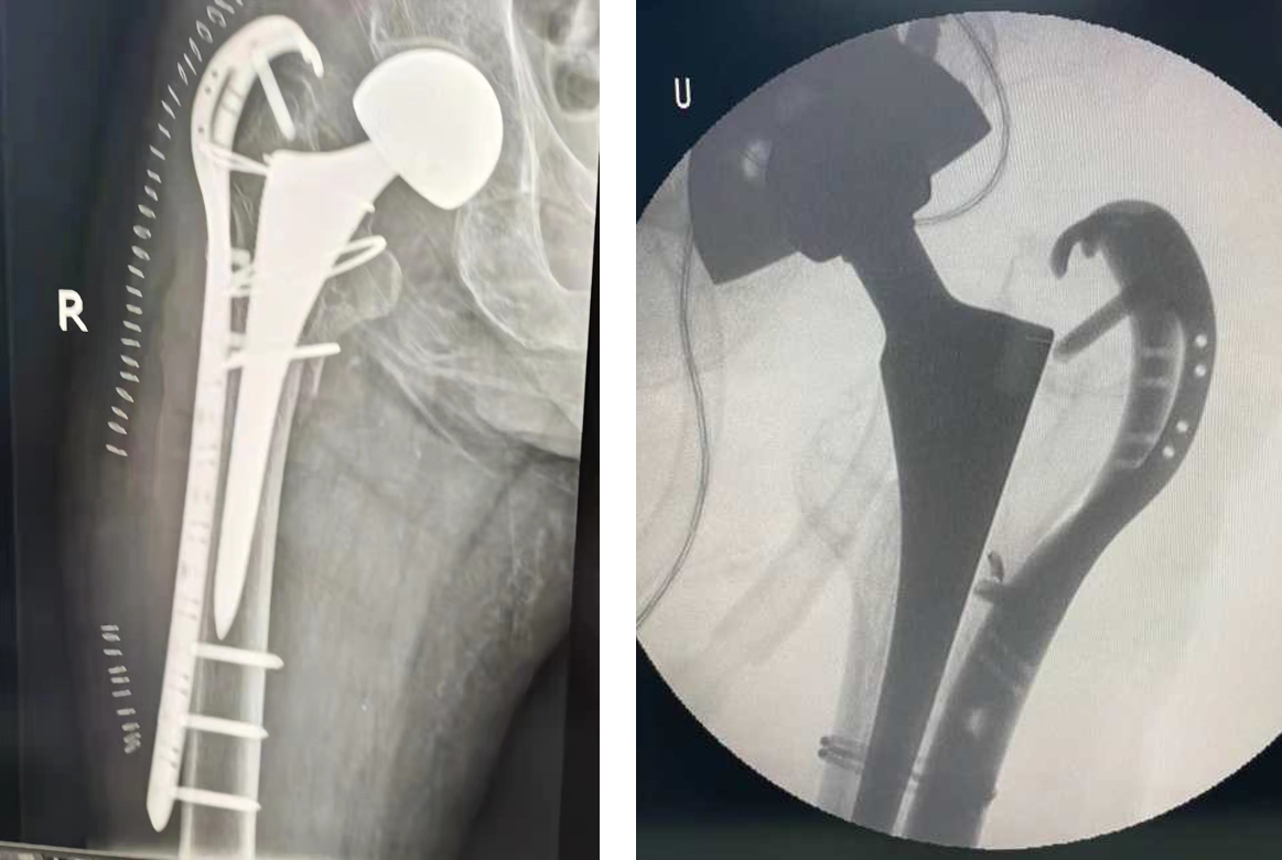 Proximal Femur Locking Plate Indications