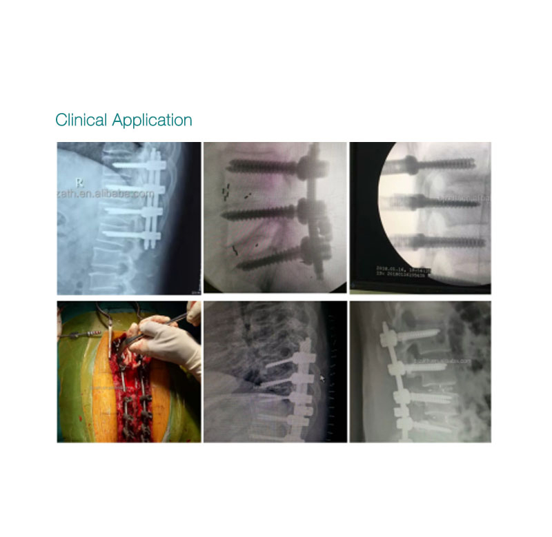 OEM CE approved Zipper Polyaxial Pedicle Screws Spine System Manufacturer, Product
