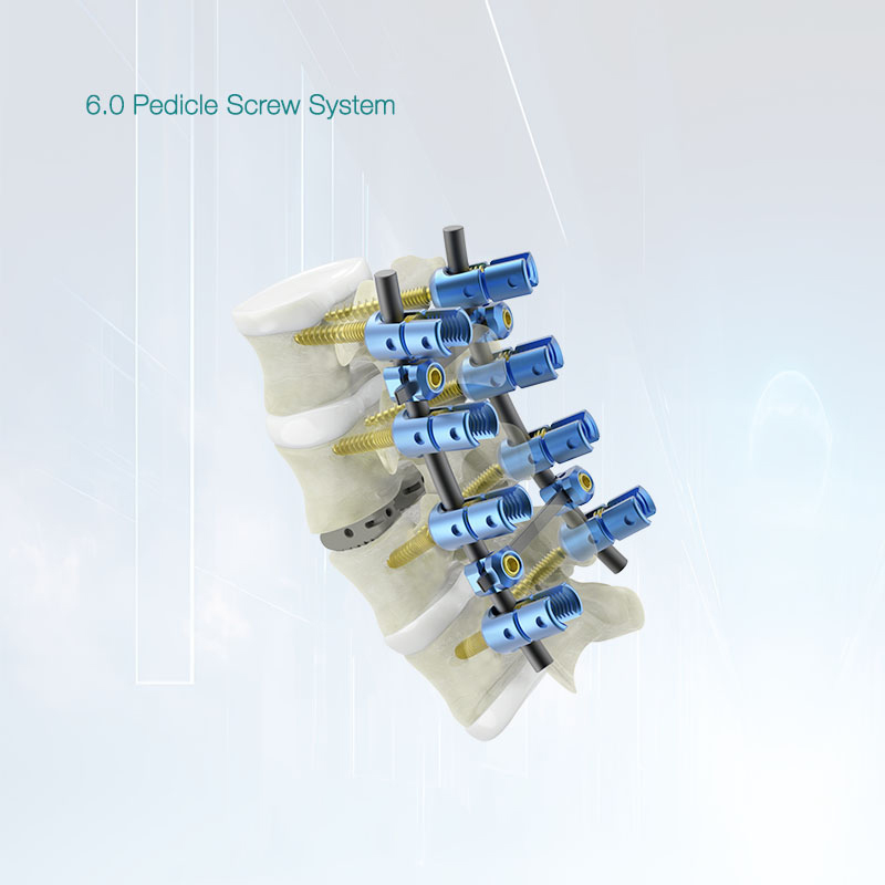 OEM CE approved Zipper Polyaxial Pedicle Screws Spine System Manufacturer, Product
