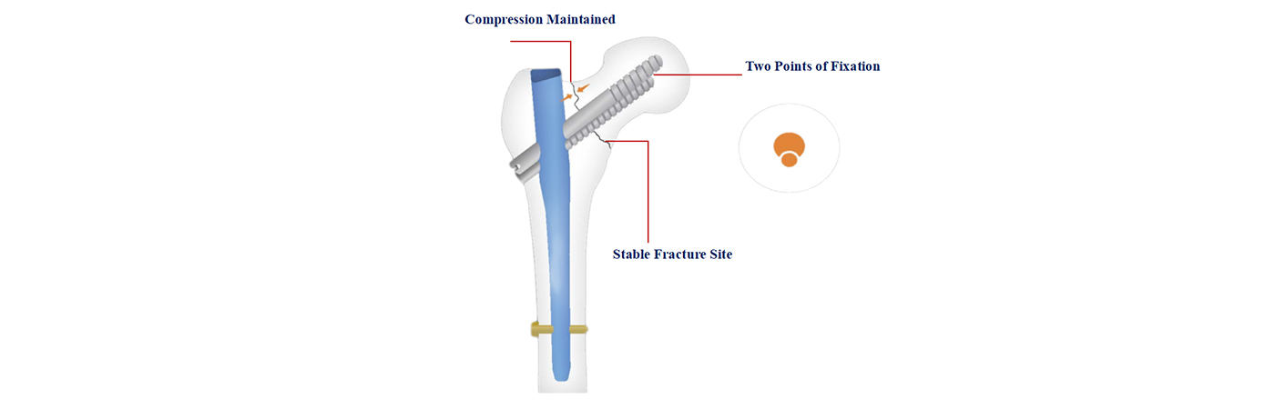 Implant Fixation