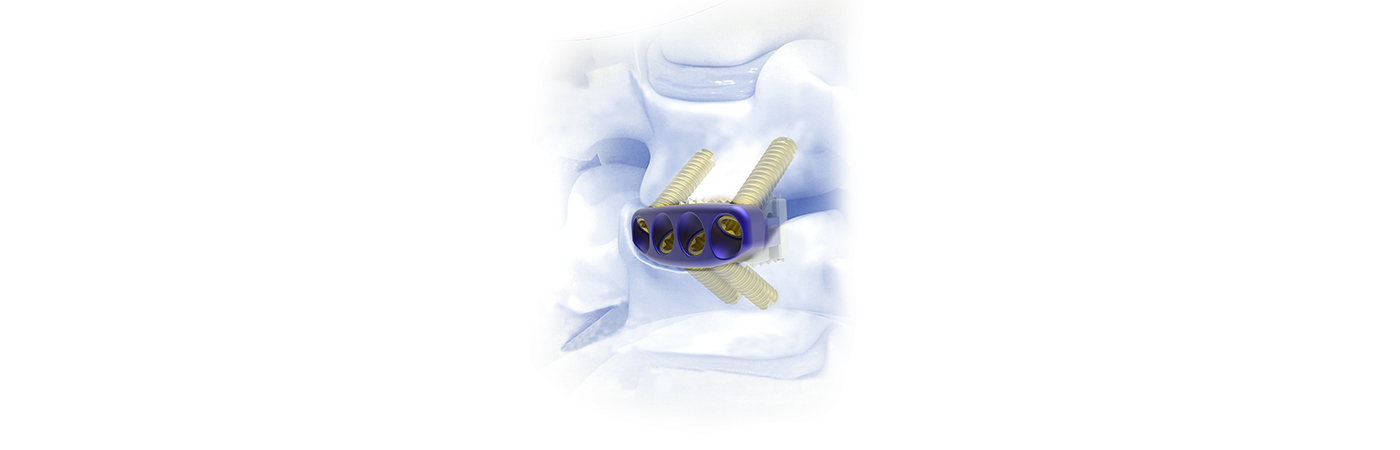 Cervical Stabilization Diagram