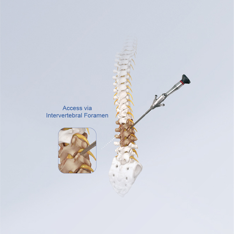 CE Certification 3.75mm Intervertebral Foramen Endoscope System Manufacturer, Exporter