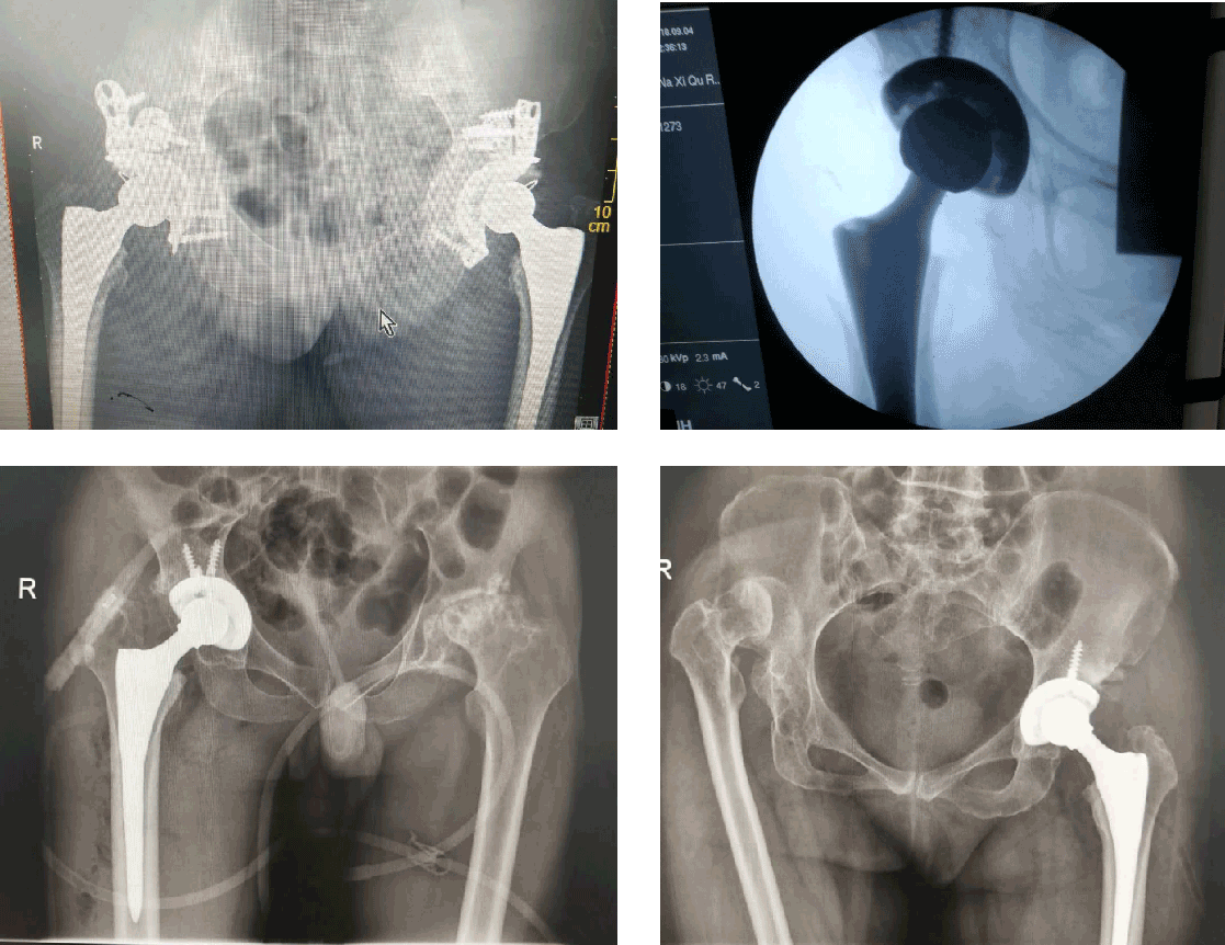 Total Hip Replacement System