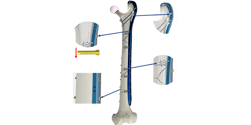 Proximal Femoral Anatomy Contouring