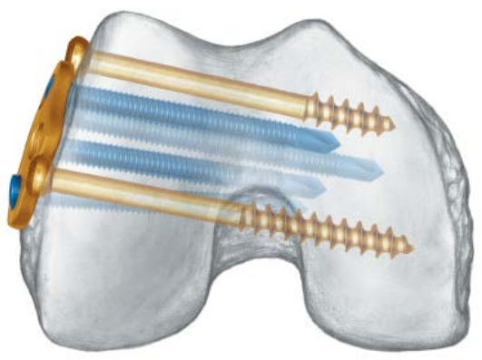 Distal Lateral Femur Plate Combi Holes Detail
