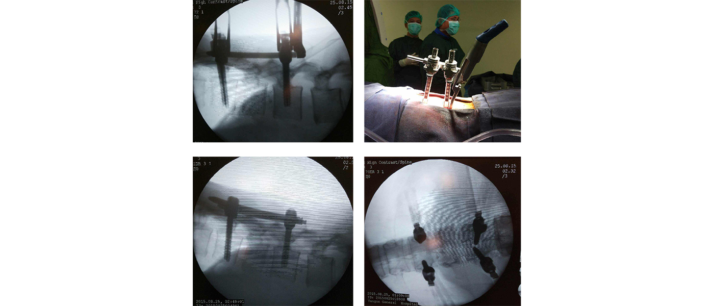 Surgical fixation positioning