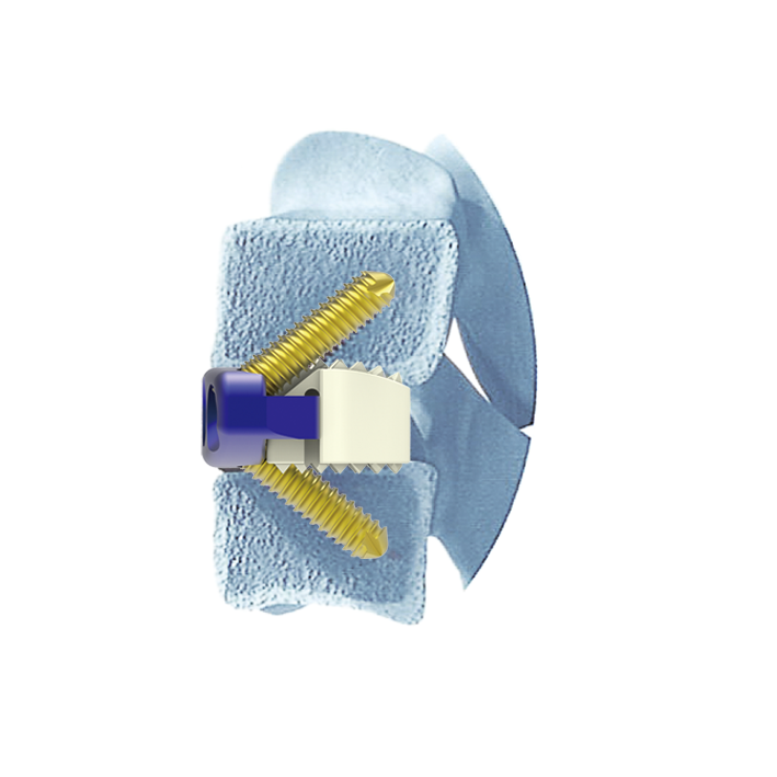 Buy ZP Cervical Cage Manufacturer CE FSC ISO Insured Supplier Exporter, Company