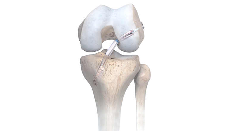 SuperFix Bone Tunnel Fixation