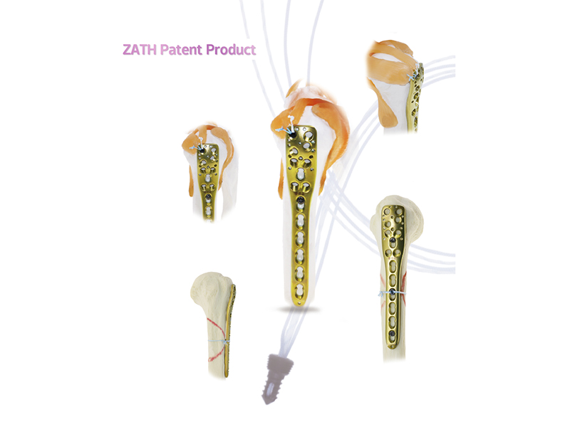 SuperFix TL Suture Anchor Application