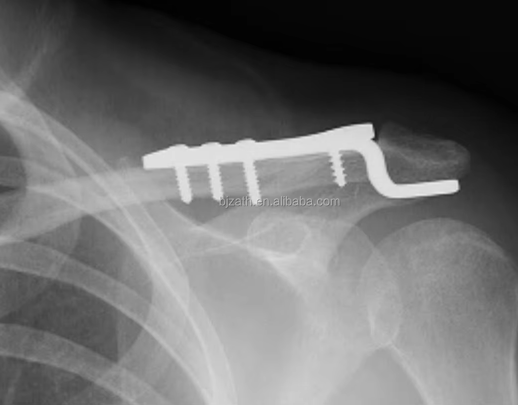 Buy Clavicle Hook Locking Compression Plate Manufacturer, Supplier