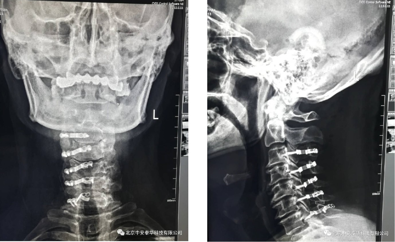 Implant Configuration