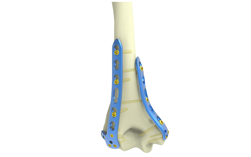 Cheap Distal Posterolateral Humerus Locking Compression Plate Suppliers, Exporter