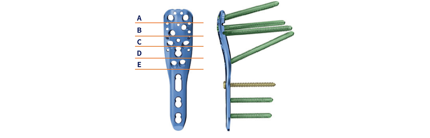 Angular Stable Construct for Osteoporotic Bone