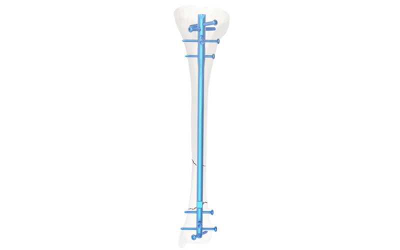 Proximal Locking Options