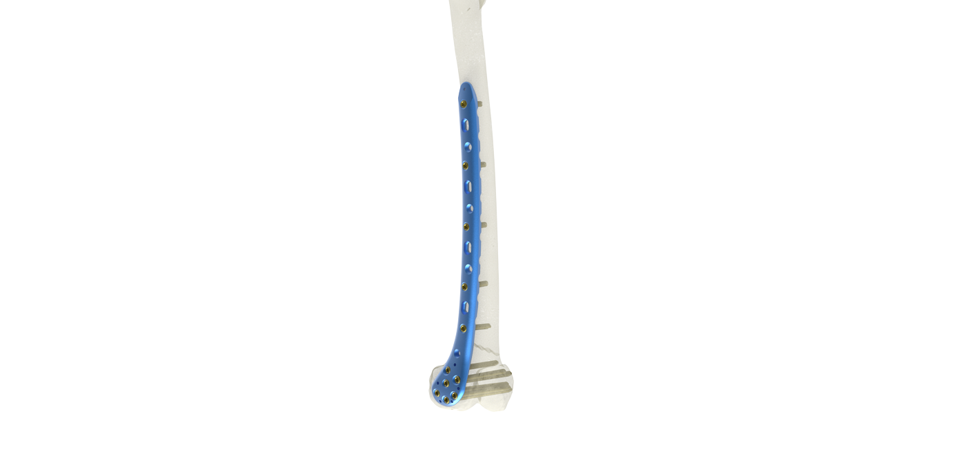 Distal Lateral Femur Plate Technical View