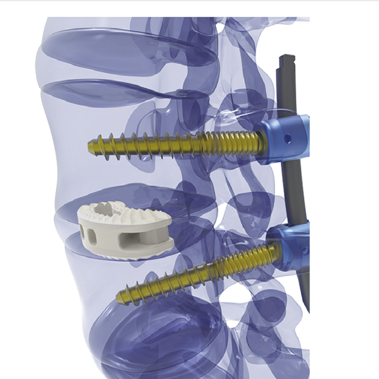 Discount ZATH Brand Cervical Interbody Cage PEEK Cage Factory CE ISO Pricelist, Quotes