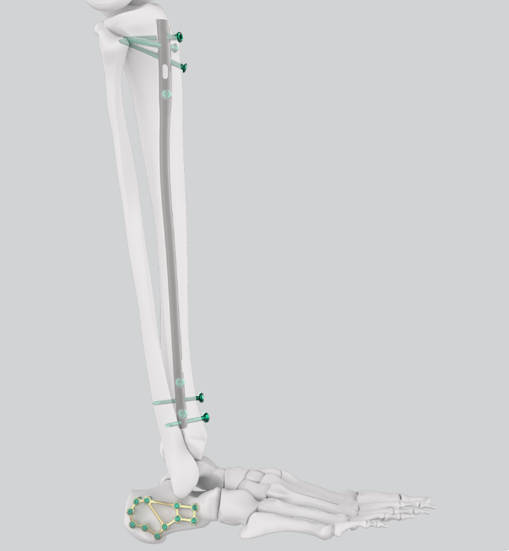 CE Certification Customized Expert Tibia Intramedullary Nail Implant  Pricelist, Products