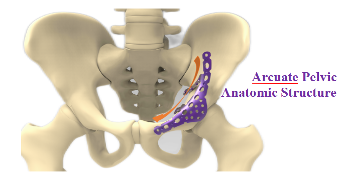 Pelvis Reconstruction Plate View 1