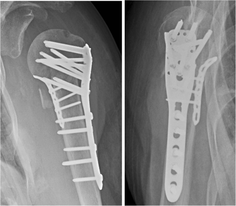 Famous Proximal Humerus Locking Compression Plate III Exporters, Product