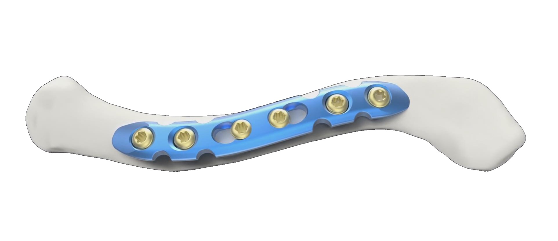 Wholesale Clavicle Reconstruction Locking Compression Plate Supplier, Exporters
