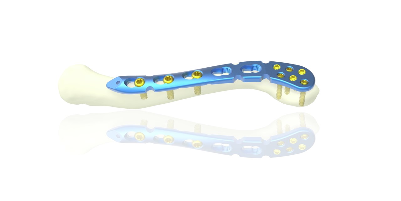 Wholesale Distal Clavicle Locking Compression Plate Manufacturers, Suppliers