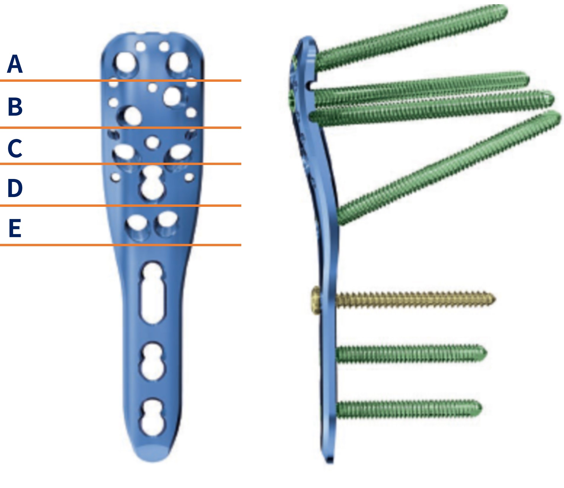 Famous Proximal Humerus Locking Compression Plate III Exporters, Product