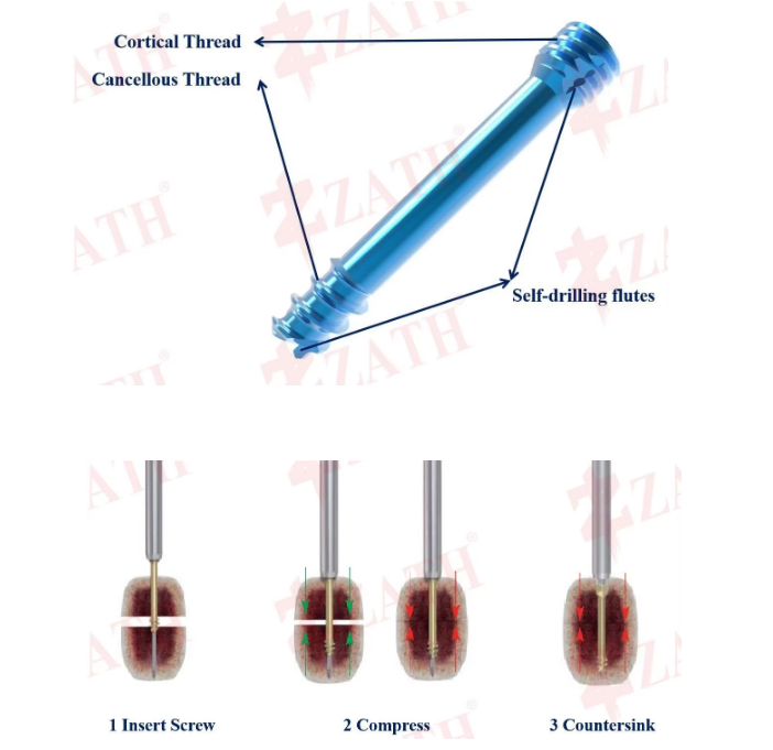 Famous Medical use double threaded cannulated screw with price Factory, Exporters
