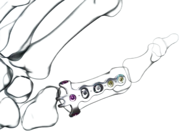 Curved Phalanx Locking Plate