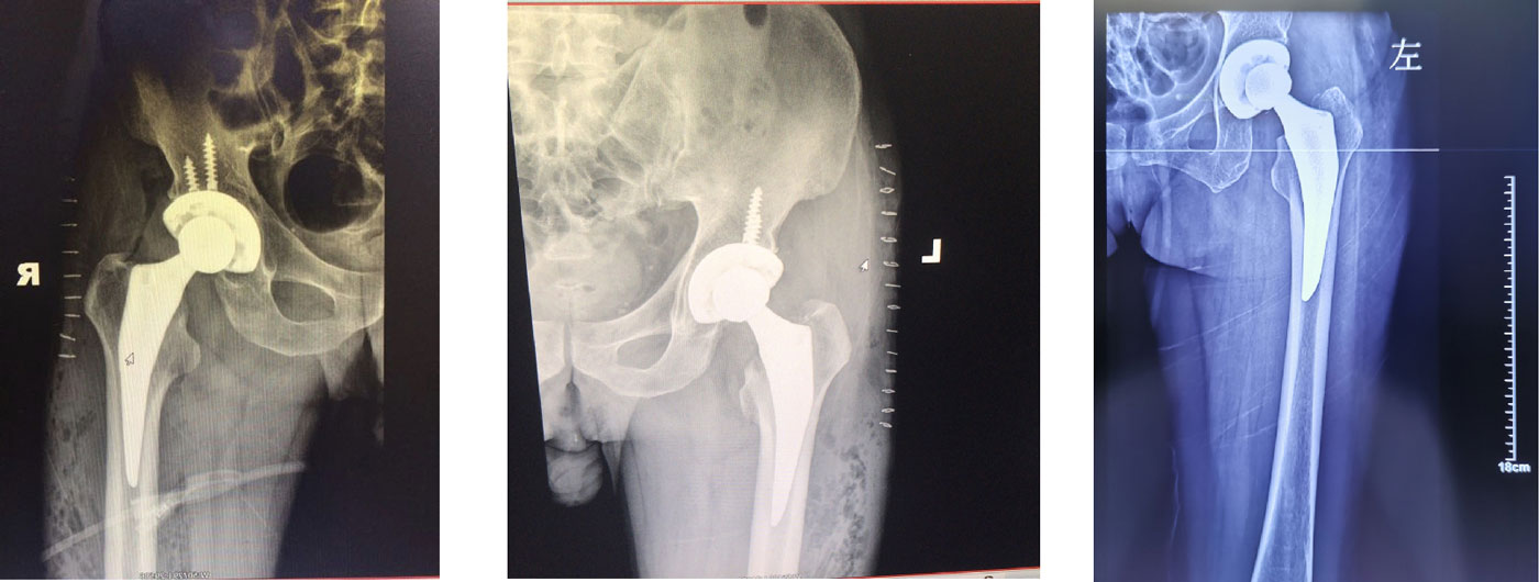 Hip Implant Overview