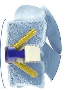One-step Locking Screw Feature