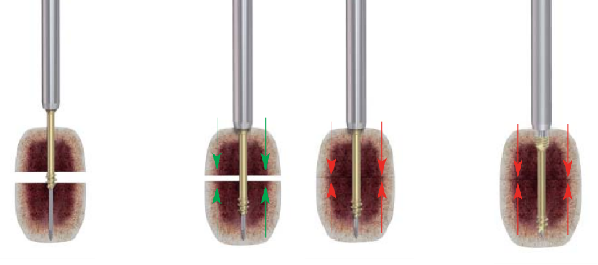 Cannulated Screw Surgical Technique