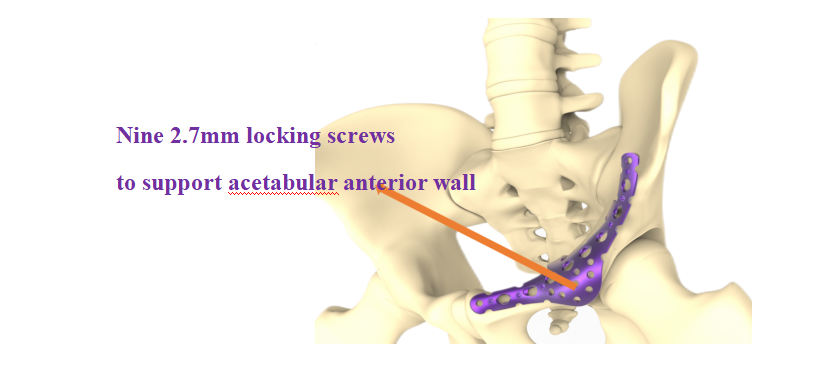 Pelvis Reconstruction Plate View 3
