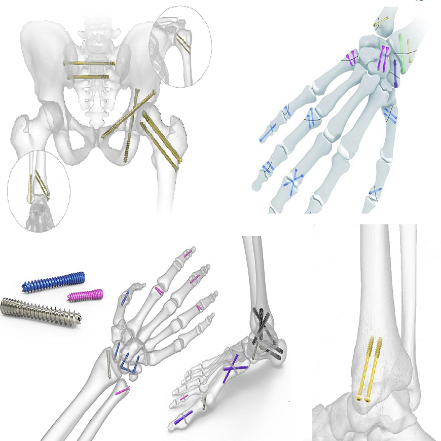Best Surgical use orthopedic implant cannulated bone screws  Exporters, Companies