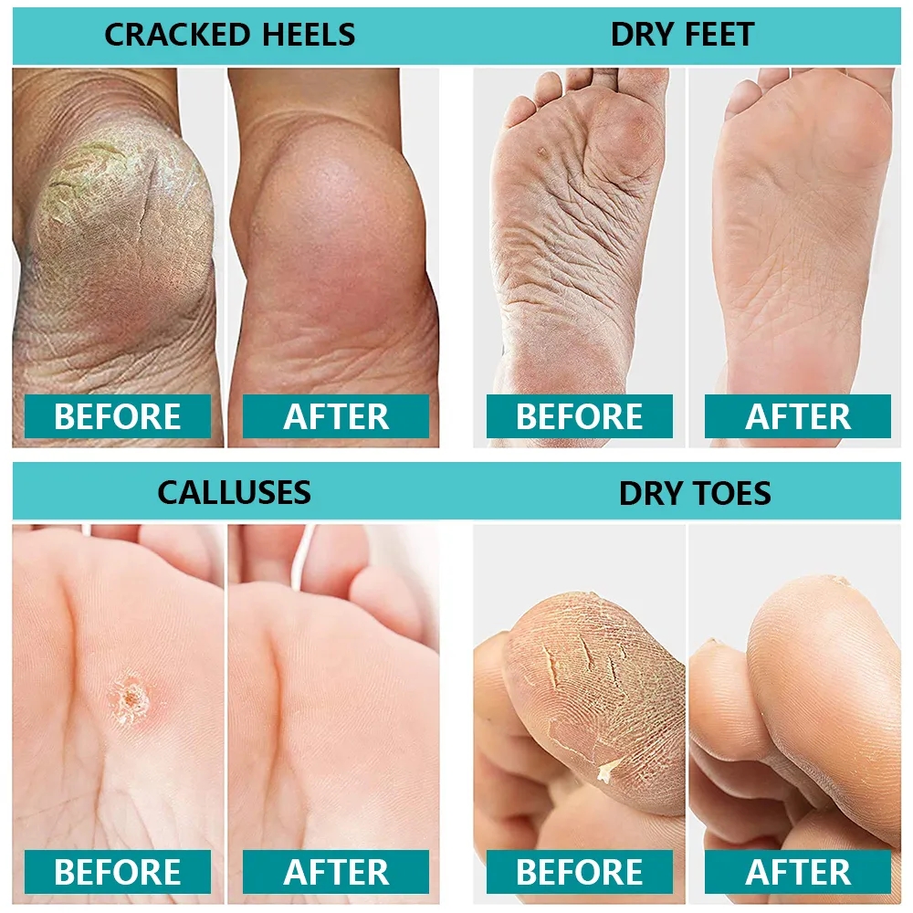 Cracked Feet Repair Cream