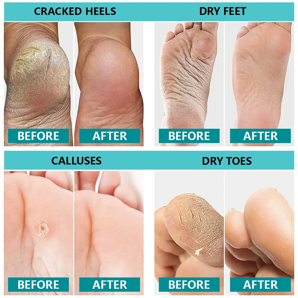 Private Label Natural Heel Repair Balm Supplier, Oem