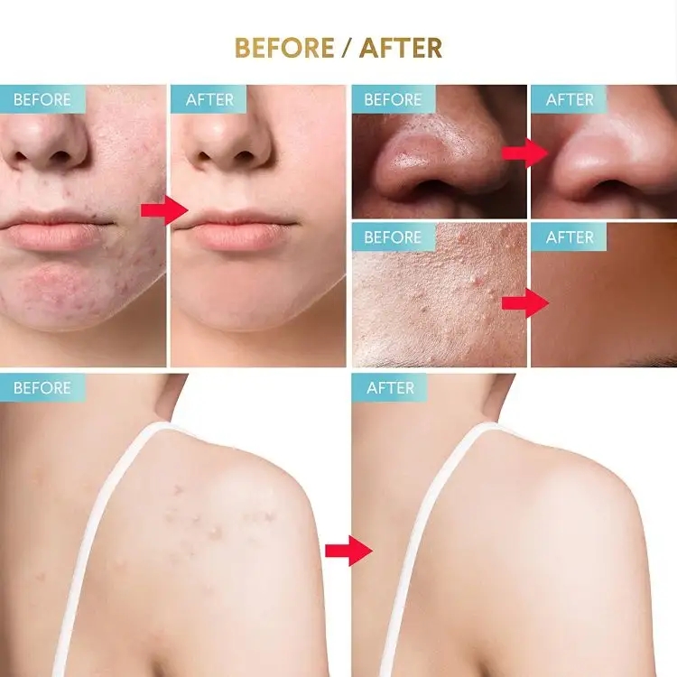 Private Label Acne Spot Treatment Serum Product Display