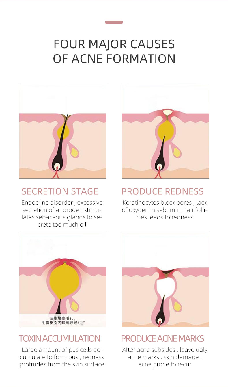 Acne Spot Treatment Serum