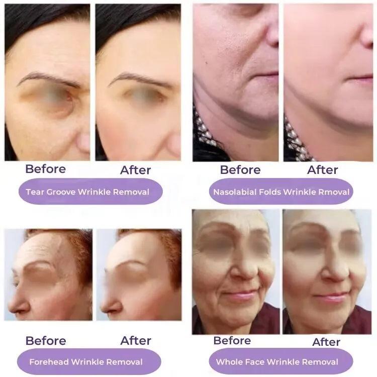 PLLA Injection Treatment Before and After Results