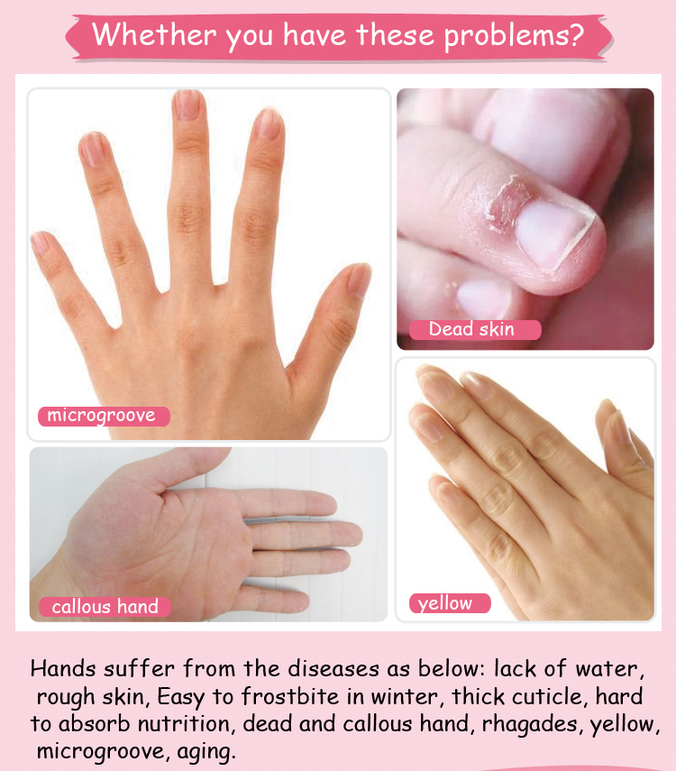 Hand Treatment