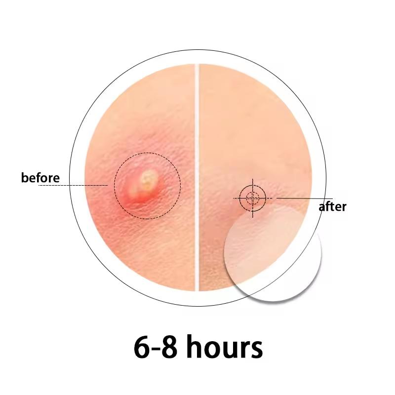 Transparent Hydrocolloid Pimple Patches: Invisible Spot Treatment for Face Zits