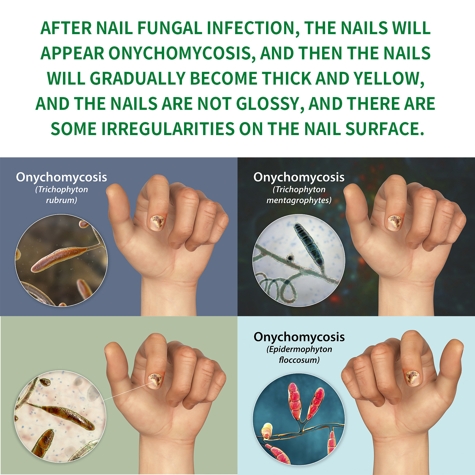 Ginger Nail Care Solution - Soft and Bright Nails, Anti-Fungal Treatment for Hands and Feet