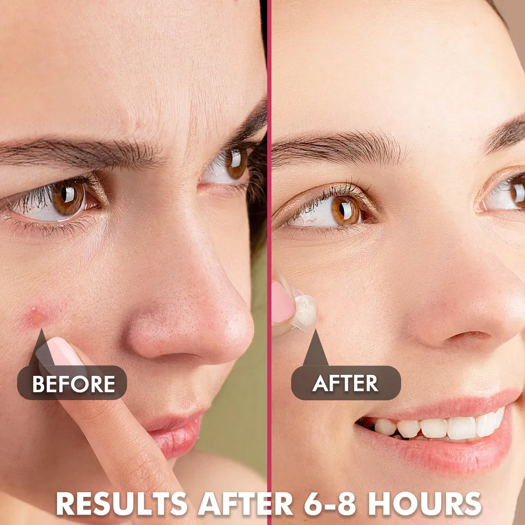 Customized Acne Pimple Treatment with Mirror Hydrocolloid Deep Skin Care Best Sell