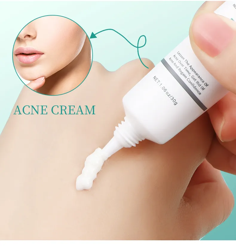 Acne Face Cream 30g Hydrating Anti-Acne Treatment Cream for Blemish Care & Oil Control