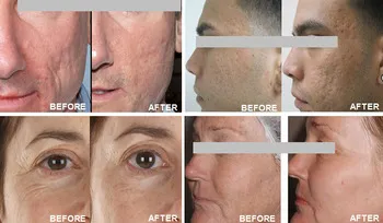 Tissue Effect