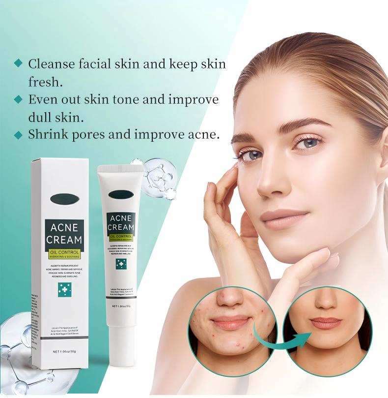 Acne Face Cream 30g Hydrating Anti-Acne Treatment Cream for Blemish Care &amp; Oil Control