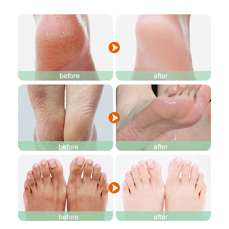 UUKKG Best Seller Foot Mask Exfoliating Scrub Pedicure Spa Socks Foot Peel Mask Feet Care for Heels Remove Dead Skin Moisturize