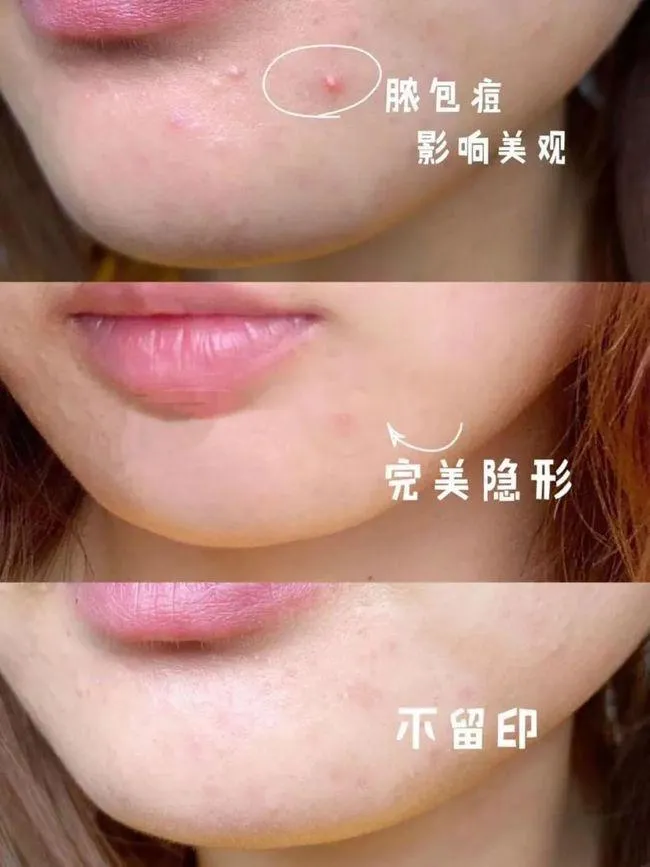 Hydrocolloid Acne Pimple Master Patch Pimple Stickers Spot Treatment Private Label